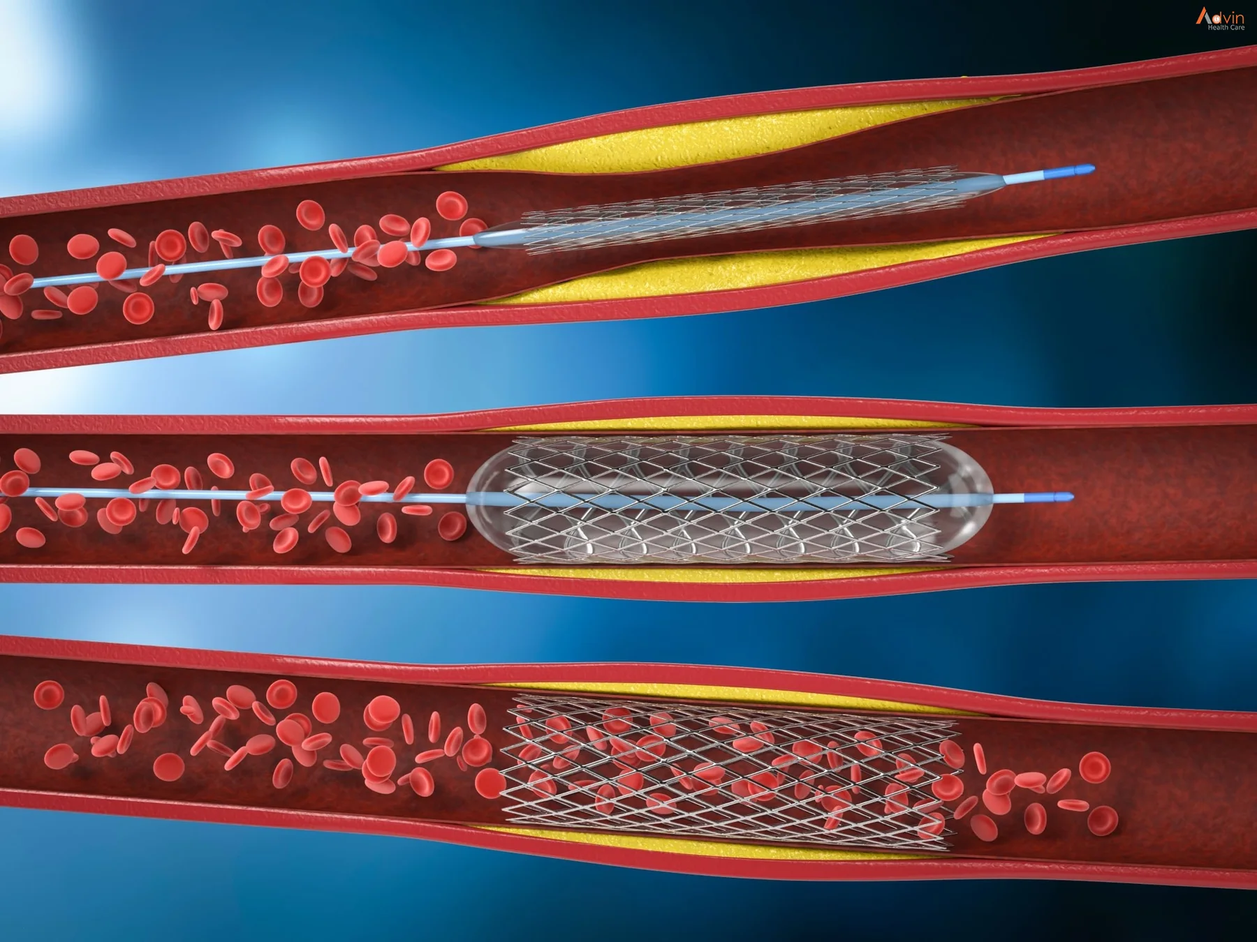 Angioplasty at Draupadi Devi Memorial Hospital